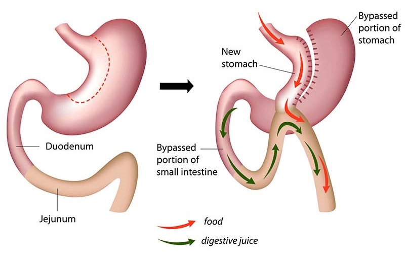 Sleeve gastrectomy illustration